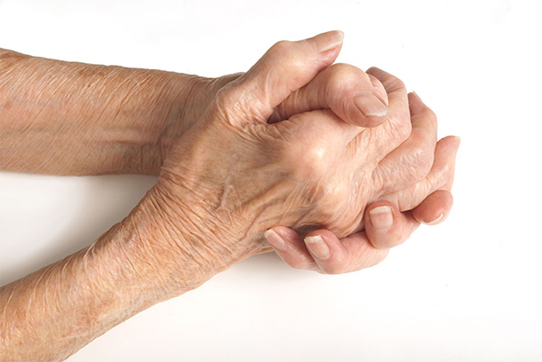 L'arthrose que dans la vieillesse? (Photo: 123RF, roywaylam)