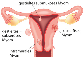 Myome