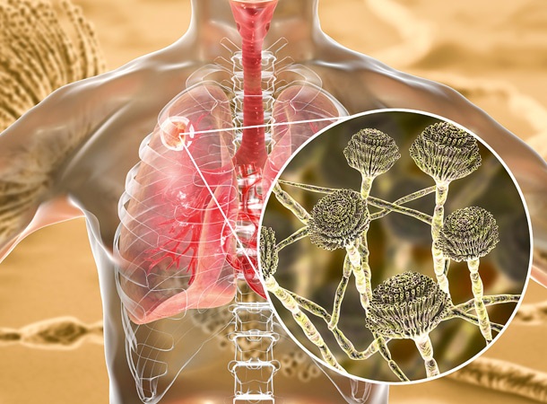 Ist es Aspergillose? (Foto: 123RF/drmicrobe) Grafik: Lunge und Pilz