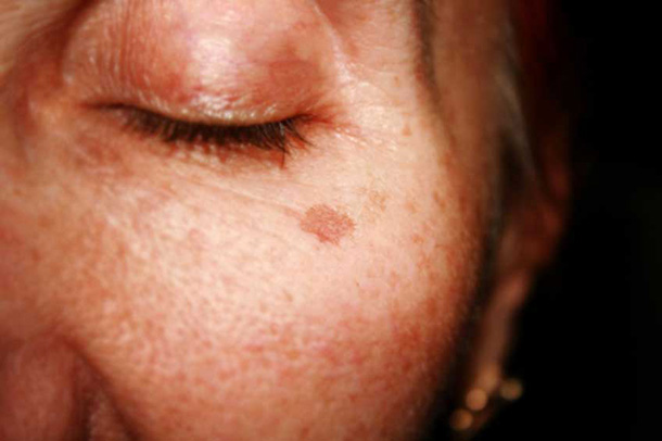 La peau: taches de vieillesse (Photo: 123RF, Iryna Timonina) vieillissement de la peau, les taches de vieillesse et la pigmentation