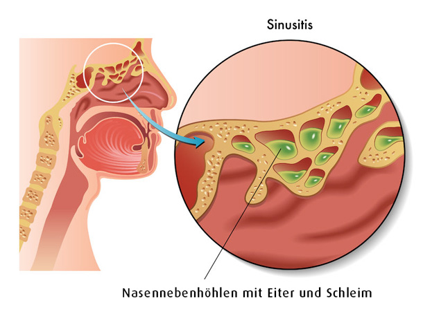 Wenn die Nebenhöhlen verstopft sind (Foto: 123RF/Roberto Biasini) Nebenhöhlen