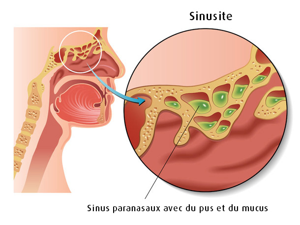 Sinusite : une inflammation des sinus frontaux (123RF) Sinusite : une inflammation des sinus frontaux