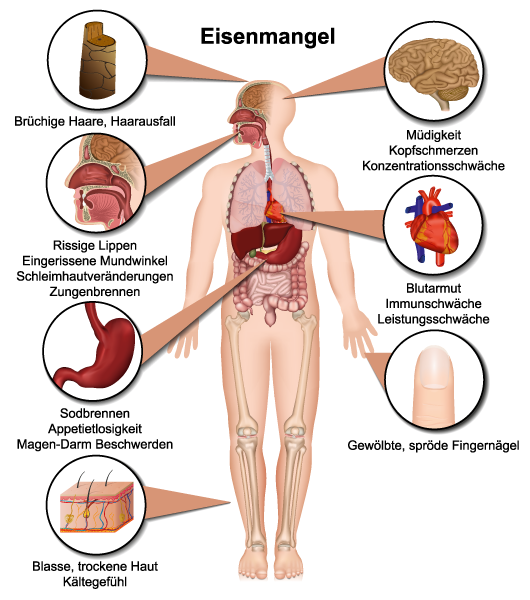 Eisenmangel im menschlichen Körper Infografik zu Eisenmangel