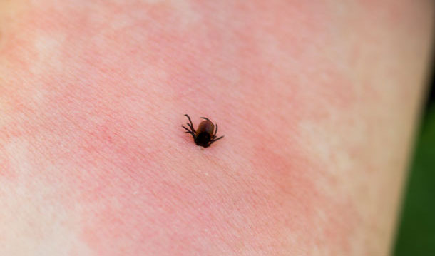 Lyme-Borreliose: Diagnose (Foto: 123RF, Viktor Yatsuk) Entzündungsreaktion auf der Heut bei einem Zeckenbiss: Eine Zecke hat sich in einen Arm verbissen, er ist stark gerötet.