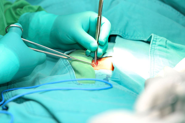 Operation eines Leistenbruchs (Foto: 123RF, dacasdo) Man sieht die Operation eines Leistenbruchs. Die Chirurgin arbeitet gerade mit einer Pinzette und einer Schere an einer offenen Stelle an der Leiste..