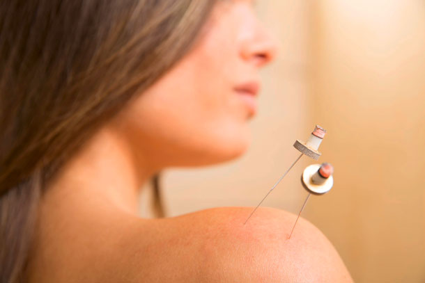 Moxibustion, thérapie de moxa (Photo: 123Rf, Tonobalaguer) Avec la thérapie au moxa, les régions du corps ou les points d'acupuncture sont réchauffés en brûlant les feuilles d'armoise séchées.