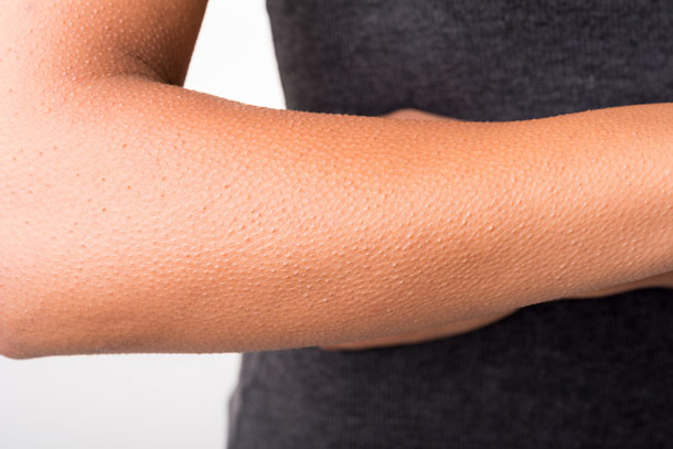 Signale der Haut richtig deuten (Foto: Fotolia) Gänsehaut