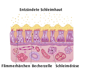 Entzündete Nasenschleimhaut (Foto: Fotolia/clusterx) Entzündete Nasenschleimhaut