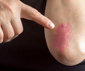 A.Vogel: Was ist Psoriasis? (Foto: 123RF, hriana) Jemand zeigt einen mit Schuppenflechten betroffenen Arm.
