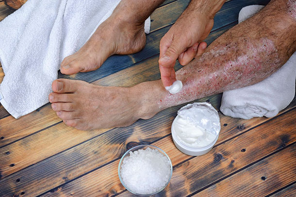 Psoriasis: Die richtige Hautpflege (Foto: 123RF, Francesco Mou) Hautkranke sollten ihre Haut auch in erscheinungsfreien Zeiten gut mit fett- und feuchtigkeitshaltigen Mittel pflegen. (Foto: Ein Mann cremt seinen betroffenes Schienbein ein. 123RF, Francesco Mou)