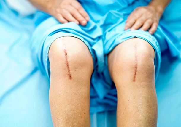 Le début optimal de la cicatrisation commence pendant l'opération. (Photo: Maurice, Sasirin Pamai) Les cicatrices peuvent être considérablement influencées en choisissant une coupe optimale et un matériau de suture parfait.