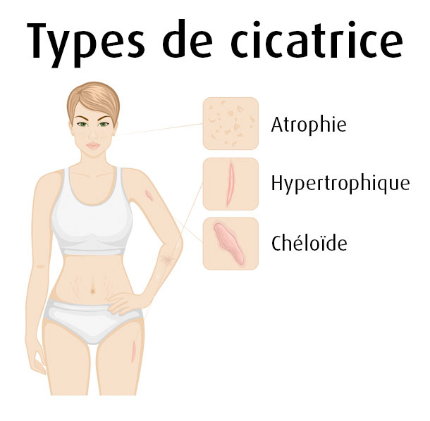Types de cicatrice (Illustration: 123RF, T. Hripliva)