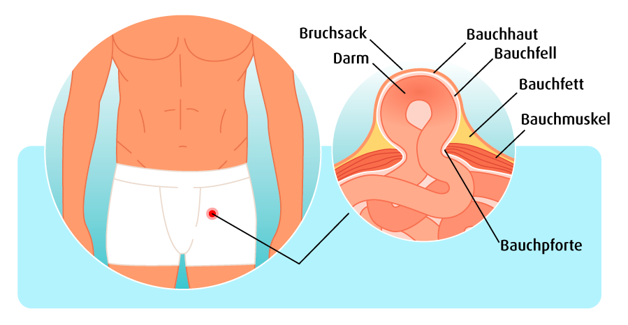 Anatomie Leistenbruch (Illustration: 123RF, martinak) Eine Infografik zeigt im Detail wie ein Leistenbruch aussieht.