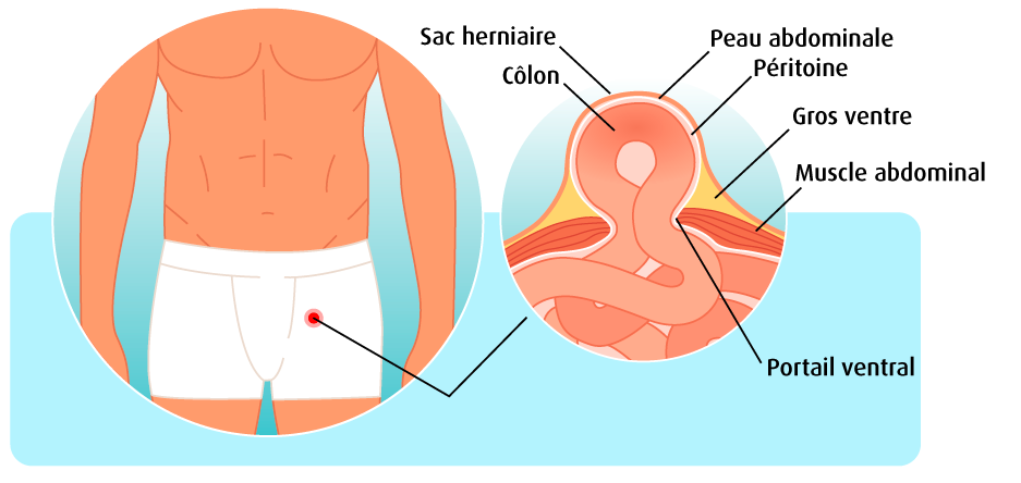Anatomie hernie inguinale (Illustration : 123RF, martinak) Une infographie montre en détail à quoi ressemble une hernie.
