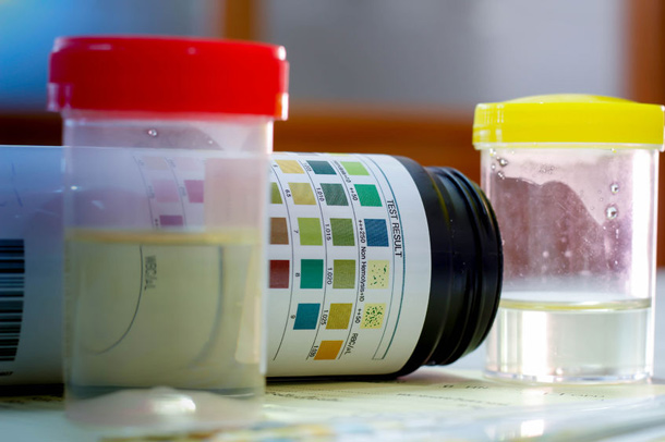 Mit einem Urintest zur Diagnose (Foto: 123RF/P. Kotsri) Urintest