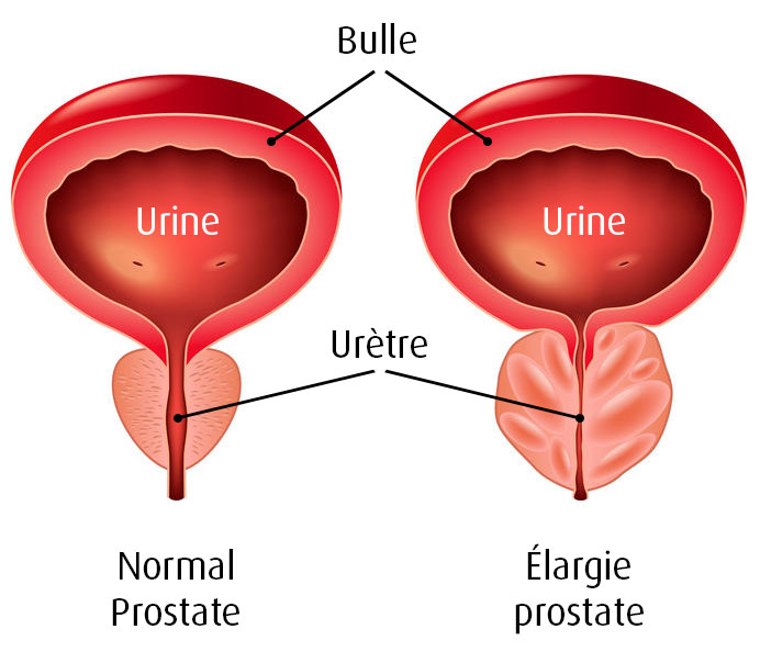 A.Vogel: Une hyperplasie bénigne de la prostate (HBP) qu'est-ce que c'est? (Infographique: 123RF, Andegro4ka)) L'infographie montre la vessie, l'urètre et la prostate. Il y a côte à côte, à titre de comparaison, une prostate normale et une hypertrophie de la prostate.