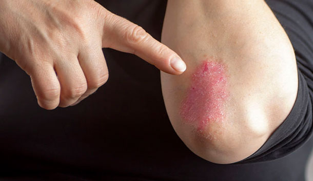 A.Vogel: Was ist Psoriasis? (Foto: 123RF, hriana) Jemand zeigt einen mit Schuppenflechten betroffenen Arm.