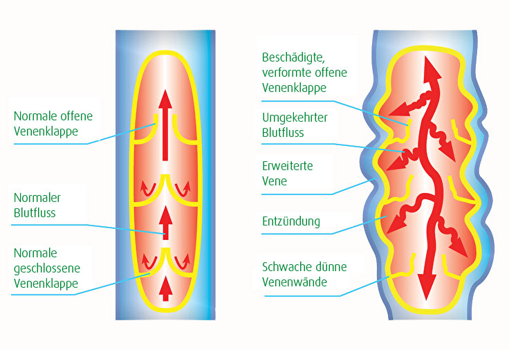 Links sieht man eine gesunde Vene. Richtiger Blutfluss und gesunde Venenklappen. Rechts sieht man eine Krampfader (kranke Vene). Beschädigte verformte offene Venenklappen, umgehrter Blutfluss und eine erweiterte Vene. 